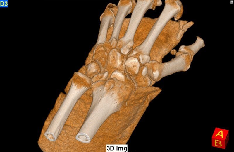 generated_Calcificazione_follow_up_con_immobilizzatore.jpg.800x600_q85