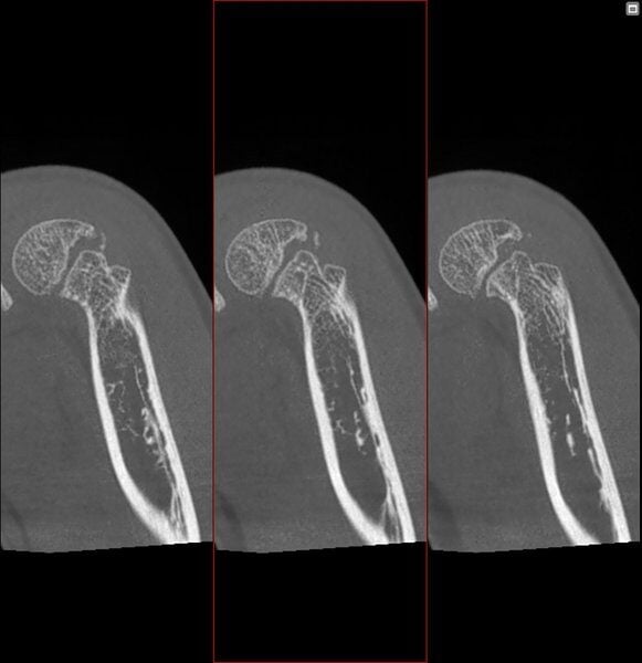 generated_Frattura_trocleare_pediatrica_2.jpg.800x600_q85