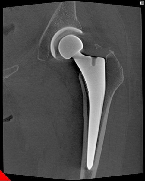 generated_Hip_prosthesis_follow-up1.jpg.800x600_q85