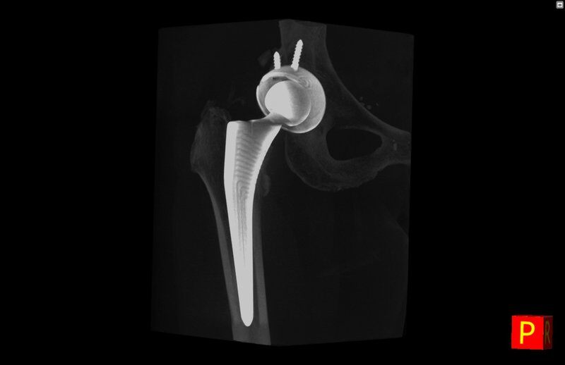 generated_Hip_prosthesis_follow-up3.jpg.800x600_q85