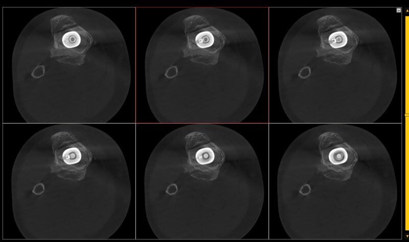 generated_Protesi_ginocchio_intramidollare_tibia-femore_2.jpg.800x600_q85