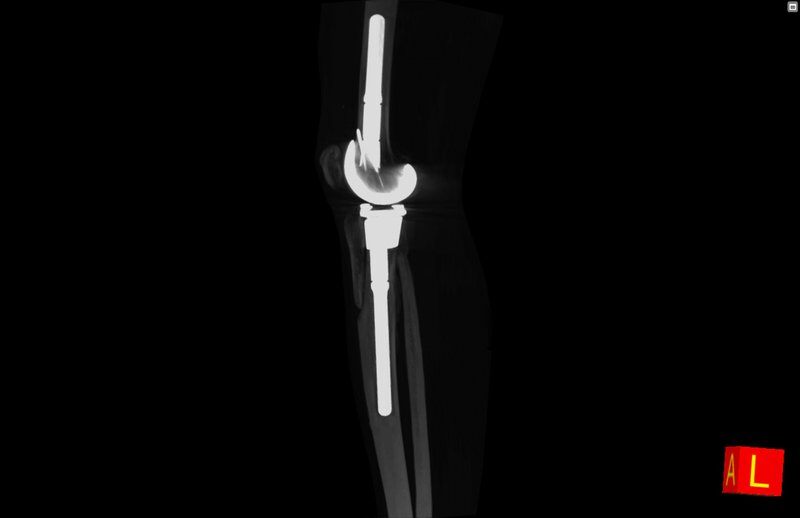 generated_Protesi_ginocchio_intramidollare_tibia-femore_3.jpg.800x600_q85