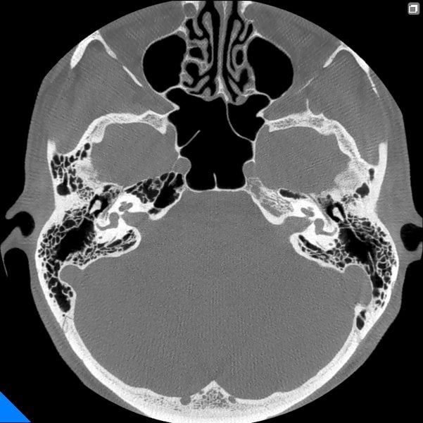 generated_bilateral_petrousal_bone.jpg.800x600_q85