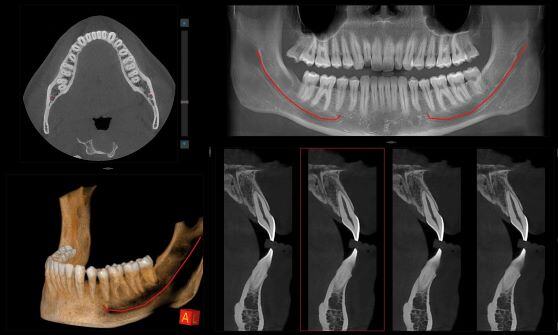 odontoiatria_cross_inclinate_su_panoramica_rid