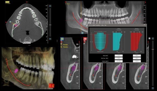 valutazione_sito_implantare_new.jpg__700x510_q85_subsampling-2